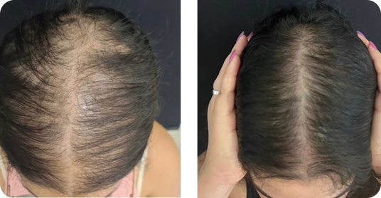 Antes e depois de tratamento capilar — primeiro caso