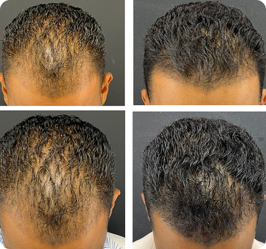 Antes e depois de tratamento capilar — terceiro caso
